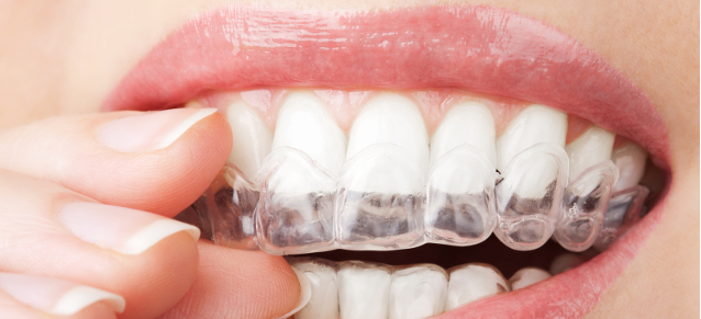 15 Must-Knows About Braces For Potential Metalmouths To 