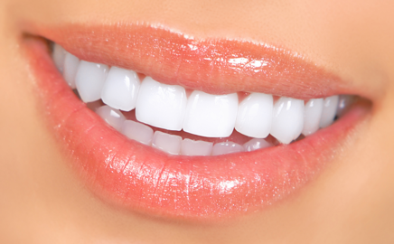 veneers