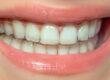 Invisalign in Fuquay Varina