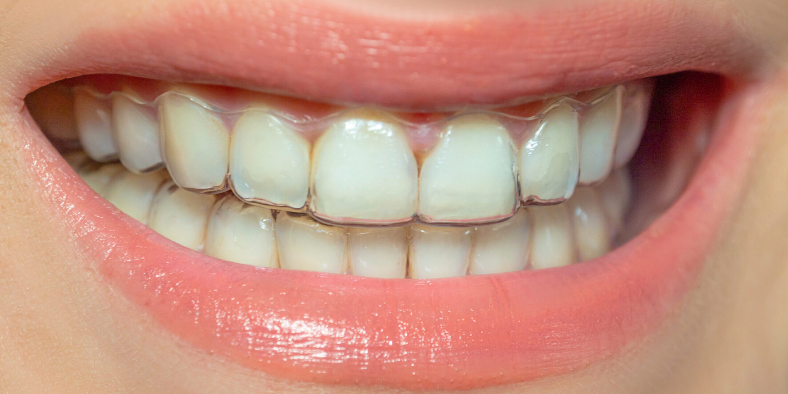 Invisalign in Fuquay Varina Invisalign in Fuquay Varina