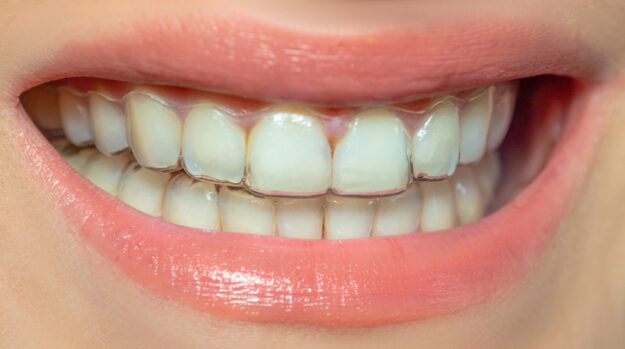 Invisalign in Fuquay Varina Invisalign in Fuquay Varina